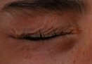 cligner des yeux pour lutter contre la sécheresse oculaire avec la méthode Chaucline
